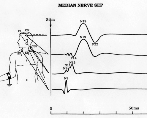 Somatosensory Evoked Potential (SSEP or SEP) Study - Electrodiagnosis
